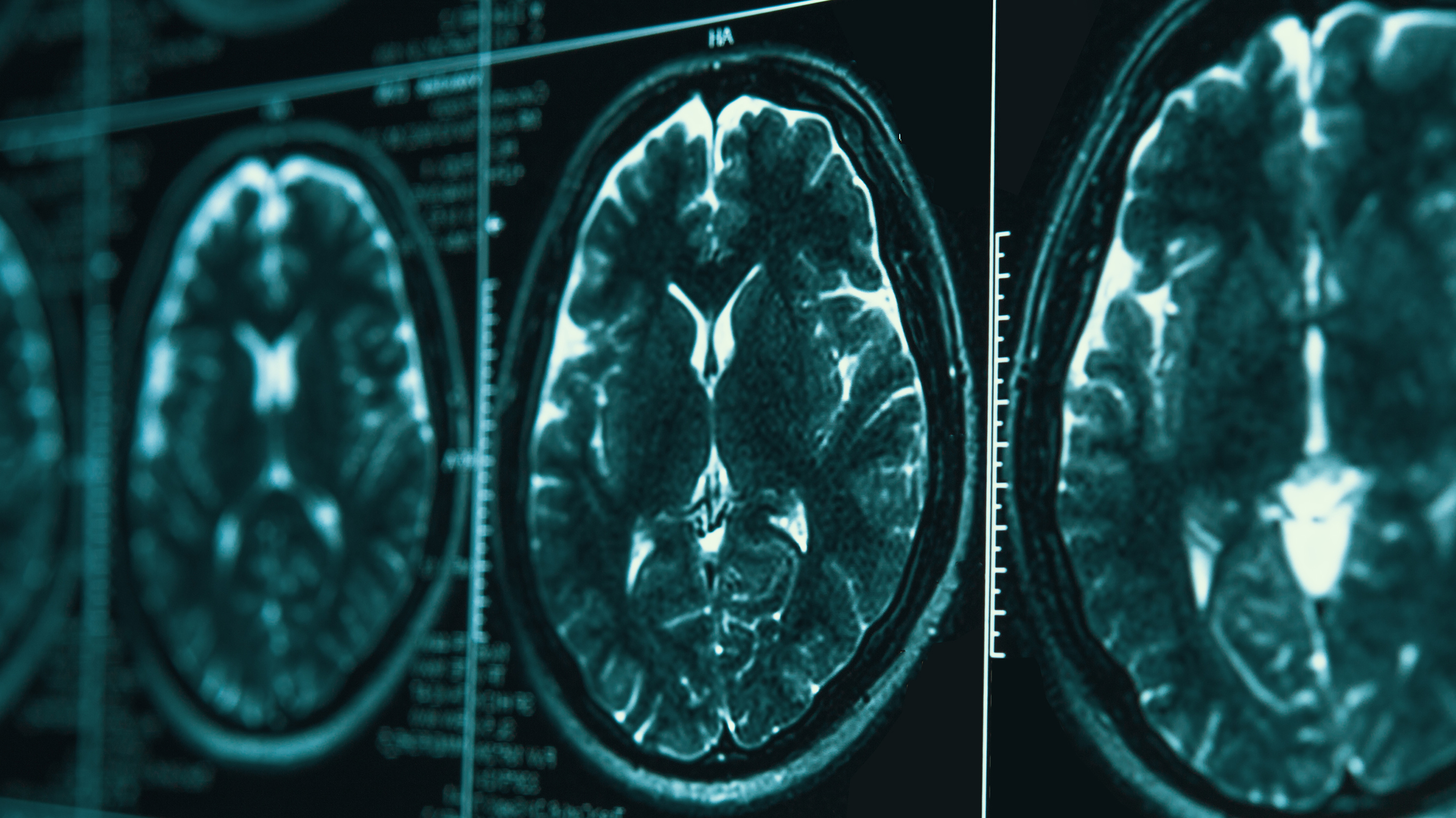 Alzheimer's Diagnosis