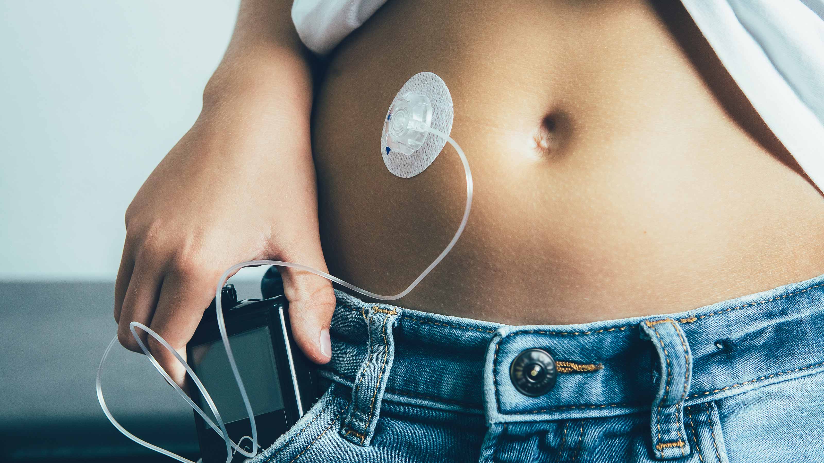 Artificial Pancreas