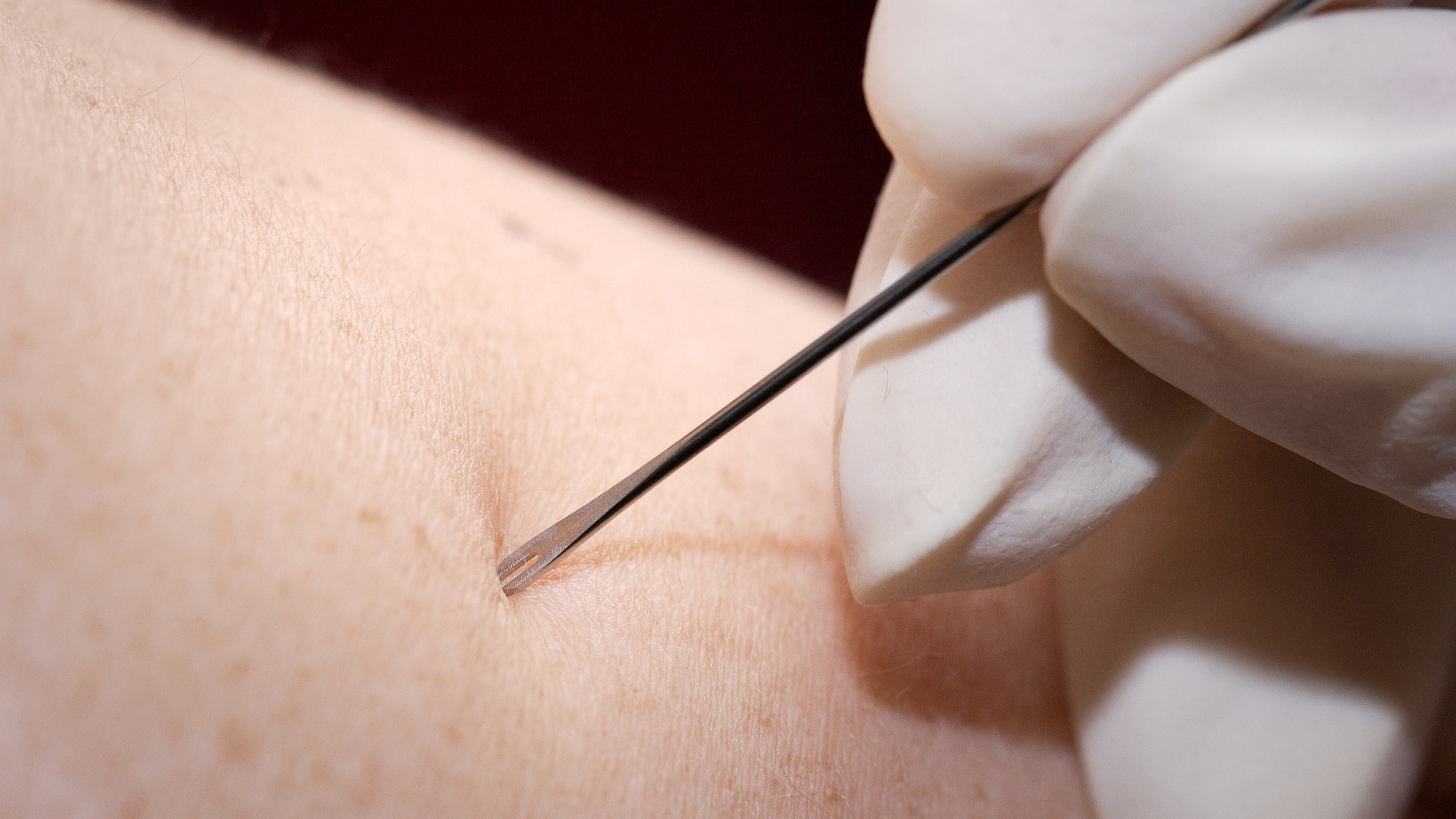 scarification vaccination