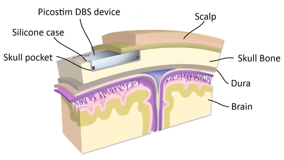 DBS device