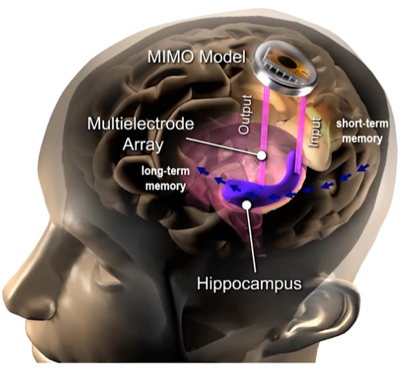 memory prosthesis