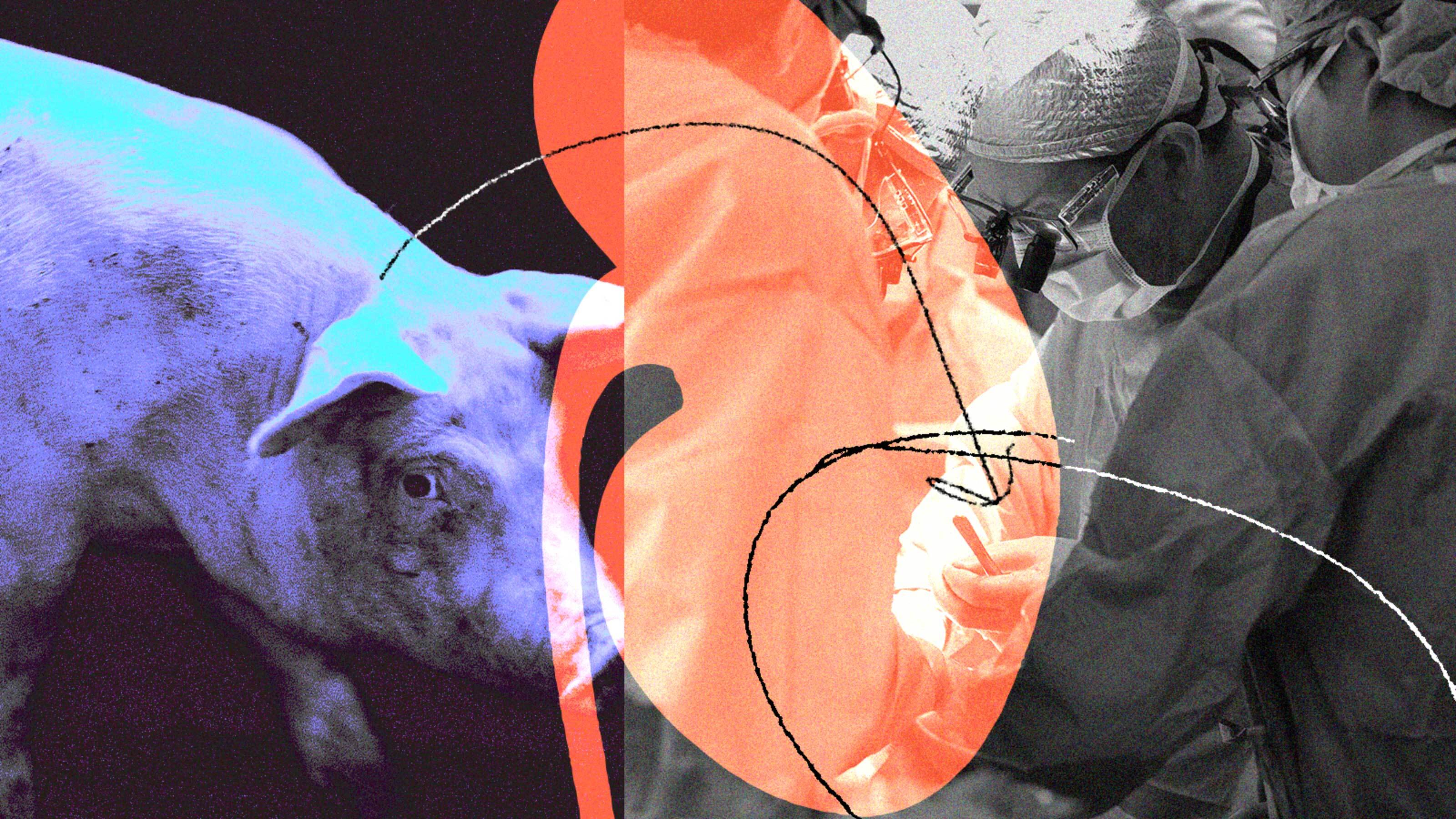 Abstract collage of a kidney, a pig, and surgeons